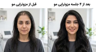 مزوتراپی مو