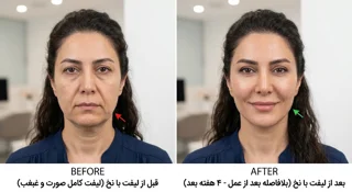 لیفت با نخ