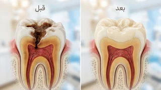 ترمیم دندان یک سطحی