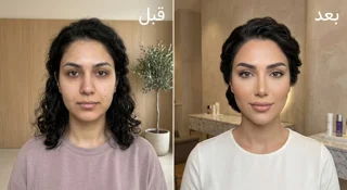 Smile line, chin, and jawline fillers