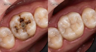 Restoration with base filling