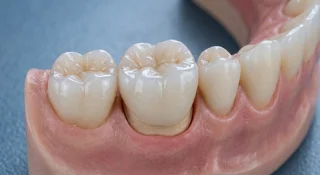 Zirconia crown